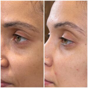 UndereyePRP