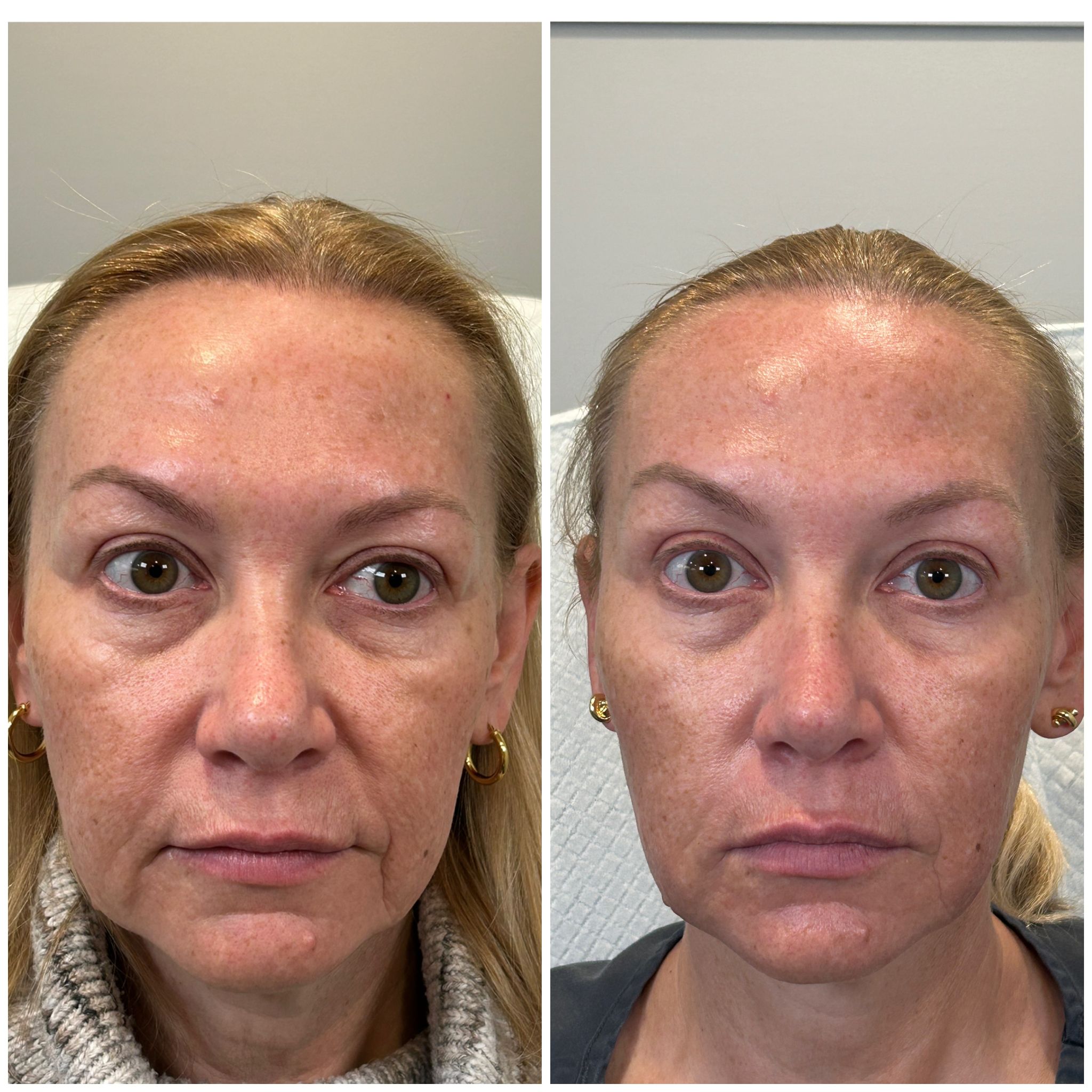 Sculptra biostimulator results - natural collagen regeneration at Rejuvae Aesthetics